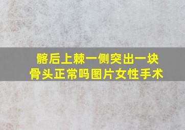 髂后上棘一侧突出一块骨头正常吗图片女性手术